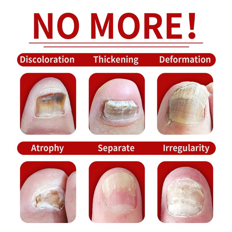 2025-Best Seller-LOVILDS™ Ginger Nail Treatment with Vitamin E & Essential Oils