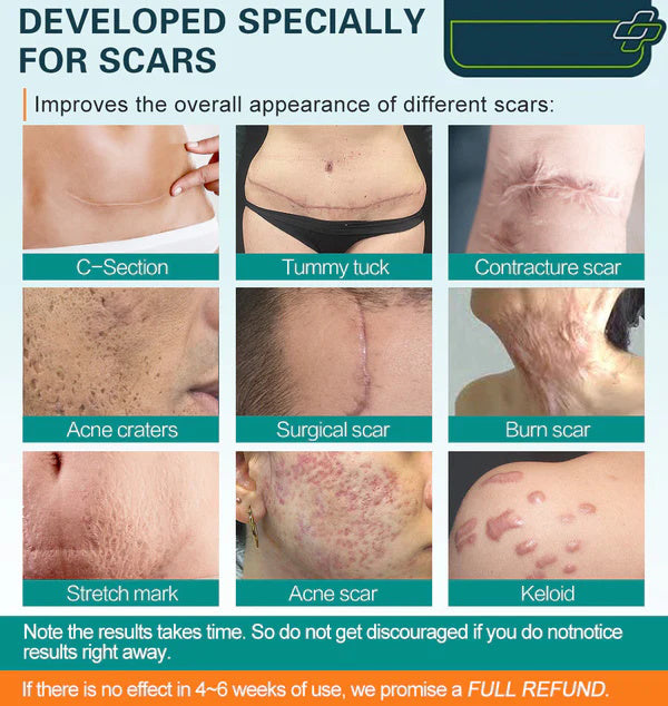 ❤️ Advanced Scar Spray For All Types of Scars - For example Acne Scars, Surgical Scars and Stretch Marks ⚡️⚡️⚡️Only 500 bottles left!